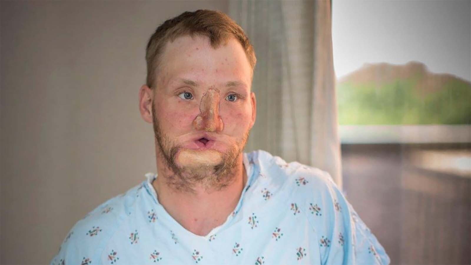 Newcastle’s Andy Sandness before his successful 2016 face transplant surgery.