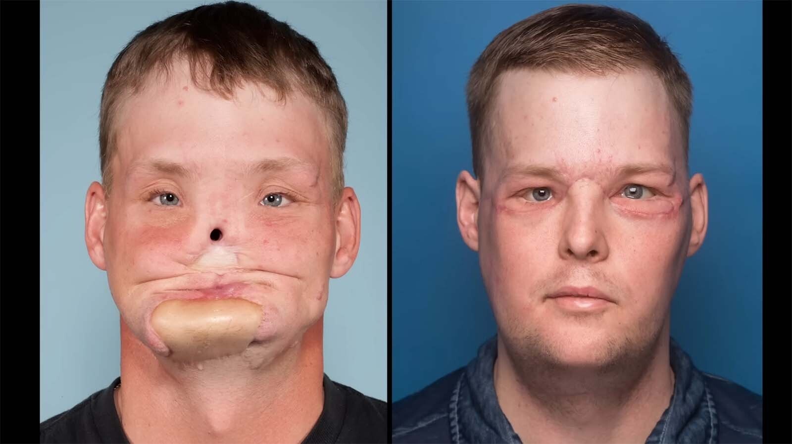 Andy Sandness before and after his face transplant surgery.