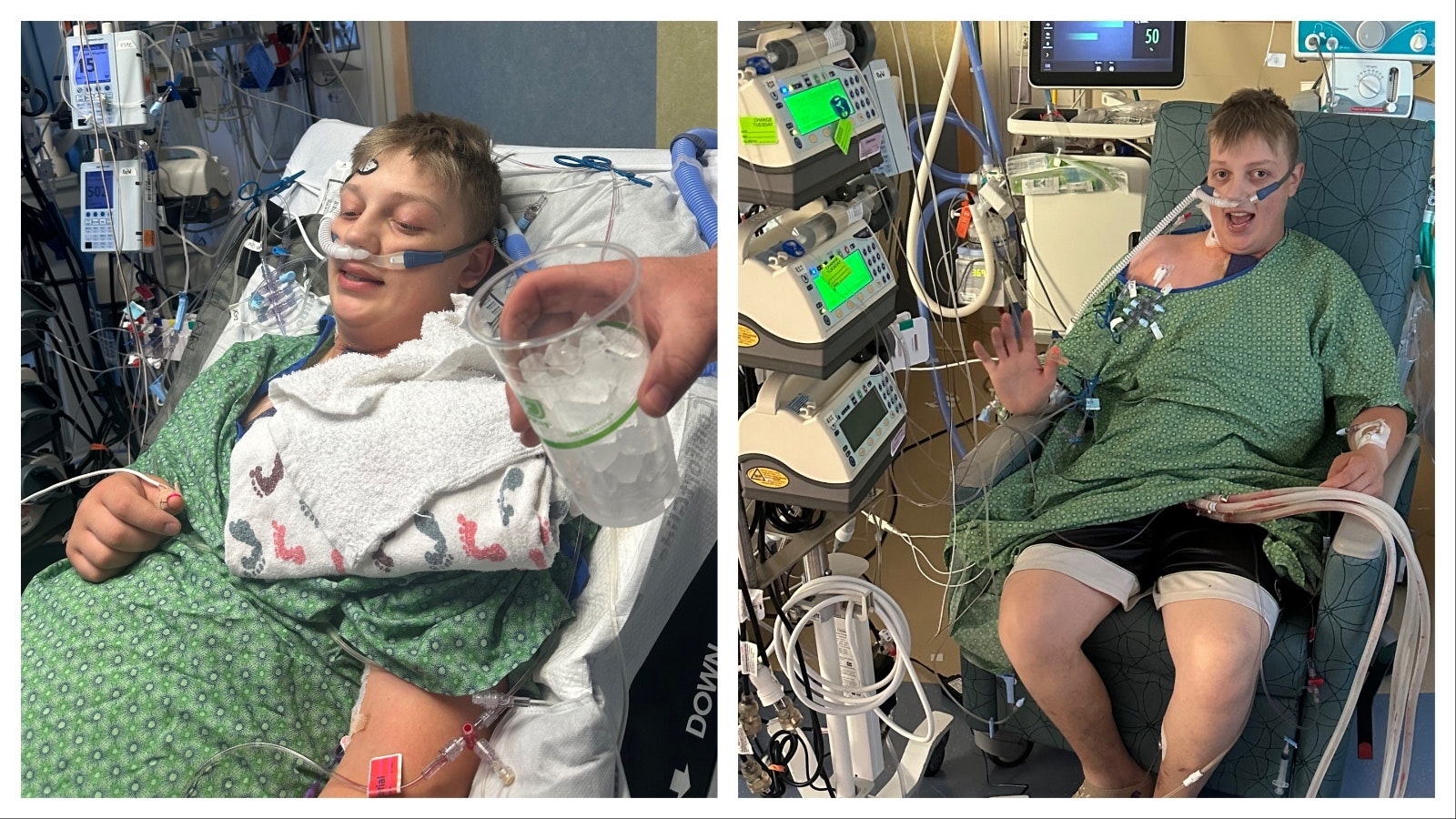 Ayden Skillman had his breathing tube out 48 hours after the heart transplant operation. At right, he sits in a chair for the first time post-op.