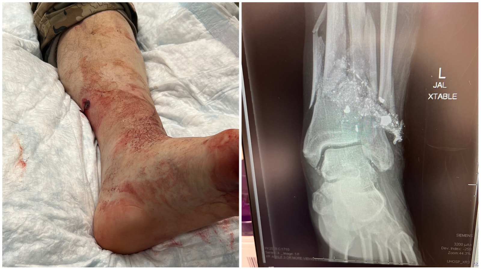 Bear shot in foot side by side 10 26 22