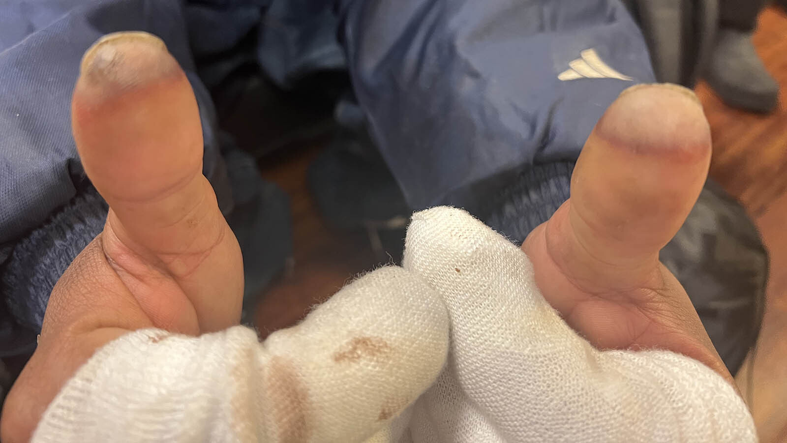 Some of the homeless who sought shelter at True Vine Community Church this past weekend showed up with various levels of frostbite. The severe cases were taken for medical attention.