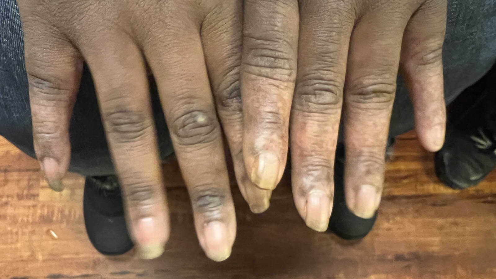 Some of the homeless who sought shelter at True Vine Community Church this past weekend showed up with various levels of frostbite. The severe cases were taken for medical attention.