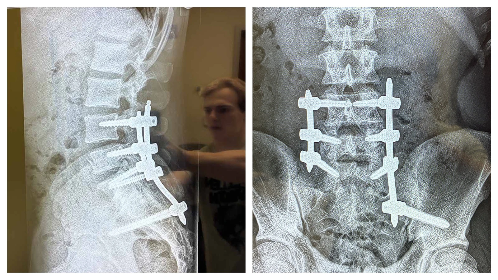 X-rays show the pins stabilizing Cooper Filipek's spine after a rodeo accident broke his back.
