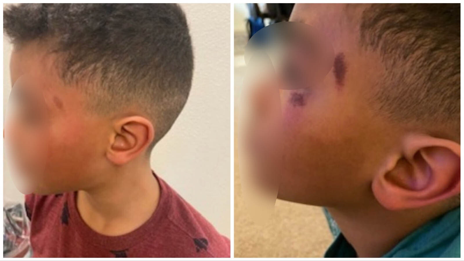 Injuries to the face of a former Cheyenne second grader allegedly caused by a Laramie County Sheriff's Office deputy, according to a lawsuit filed Tuesday. The child's identifying features have been blurred by Cowboy State Daily.
