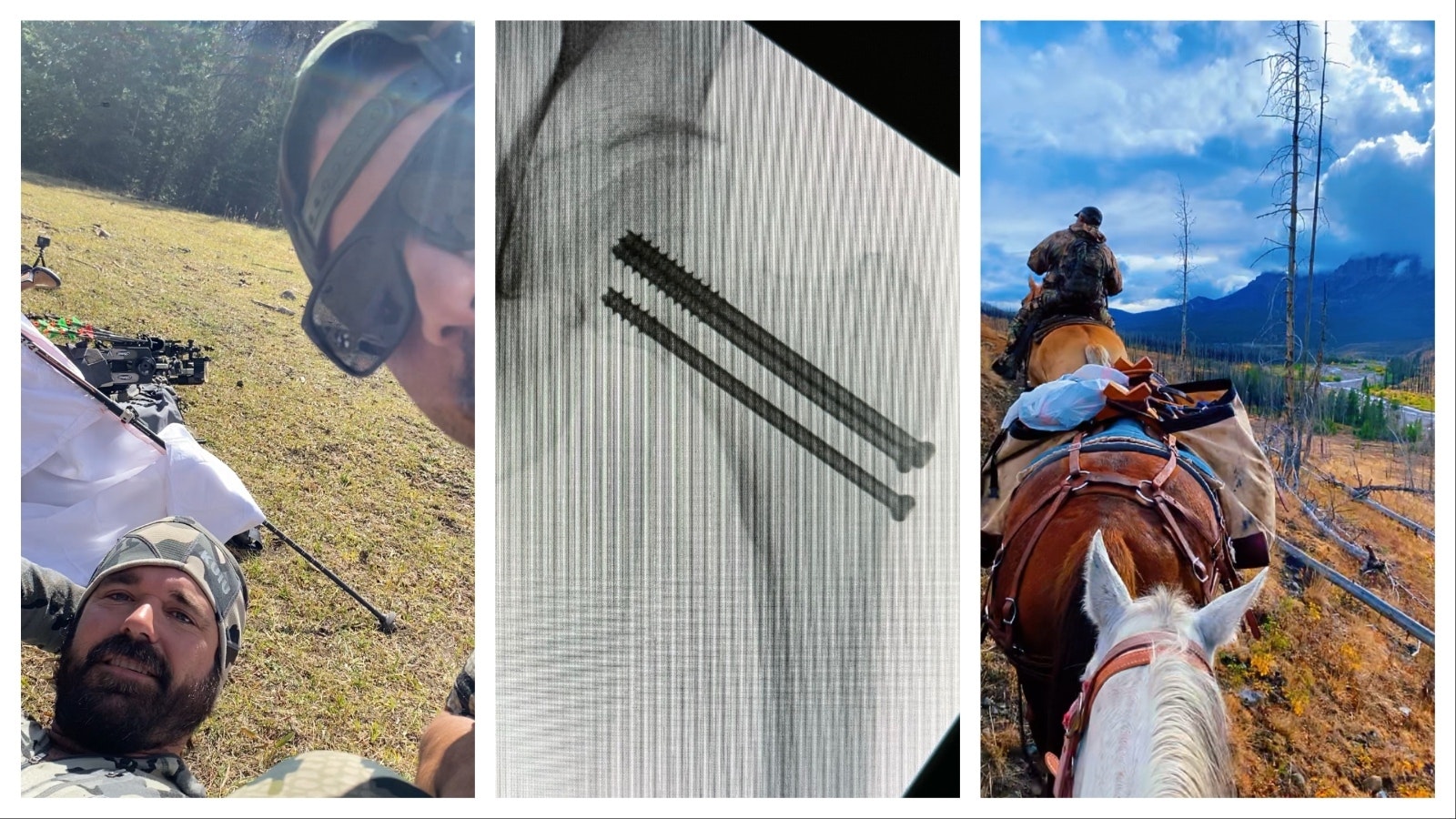 Left: David Mercado of Casper waits for a rescue helicopter to come for his friend, Neil Richard of Texas, after Ricard was bucked off his horse in the remote Wyoming backcountry and suffered a broken femur. Middle: Texas resident Neil Richard was on his first Wyoming elk hunt when he was bucked off a horse and suffered a broken femur. Doctors put several bone screws into his leg. Right: David Mercado, along with his father, son and a friend from Texas, ventured into remote country near Dubois for an elk hunt. The trip turned into a disaster – with a broken leg and a grizzly attack – but everybody made it back alive.