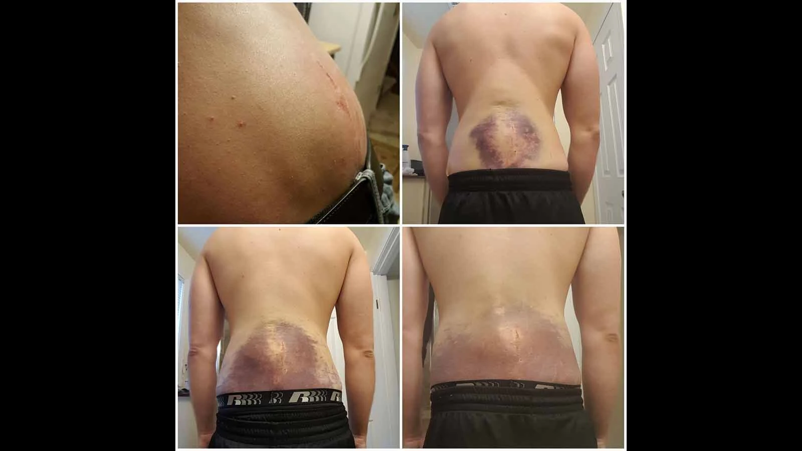 A violent struggle with a fugitive left Wyoming bail bondsman James Pulver with a massive hematoma and deep bruising across his lower back. 
