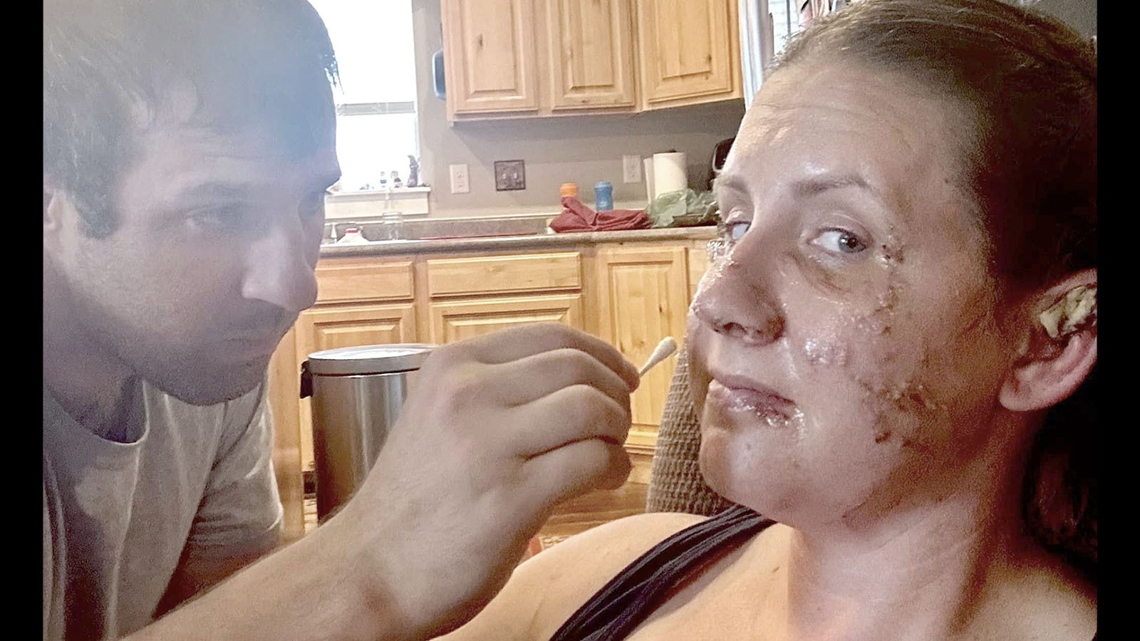 Jeff Royce of Bozeman, Montana applies medicine to bite wounds that his wife, Jen suffered earlier this month during an otter attack on the Jefferson River.