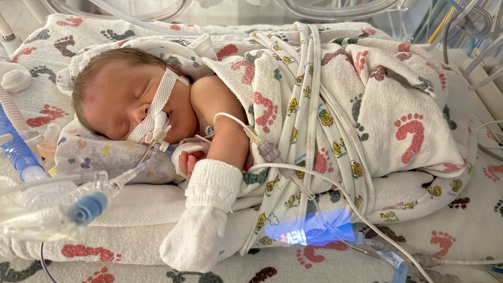Lorelai Hockaday shortly after her premature birth June 20 in Casper. What initially appeared to be complications from prematurity was later diagnosed as a rare developmental lung disorder tied to a FOXF1 gene mutation.