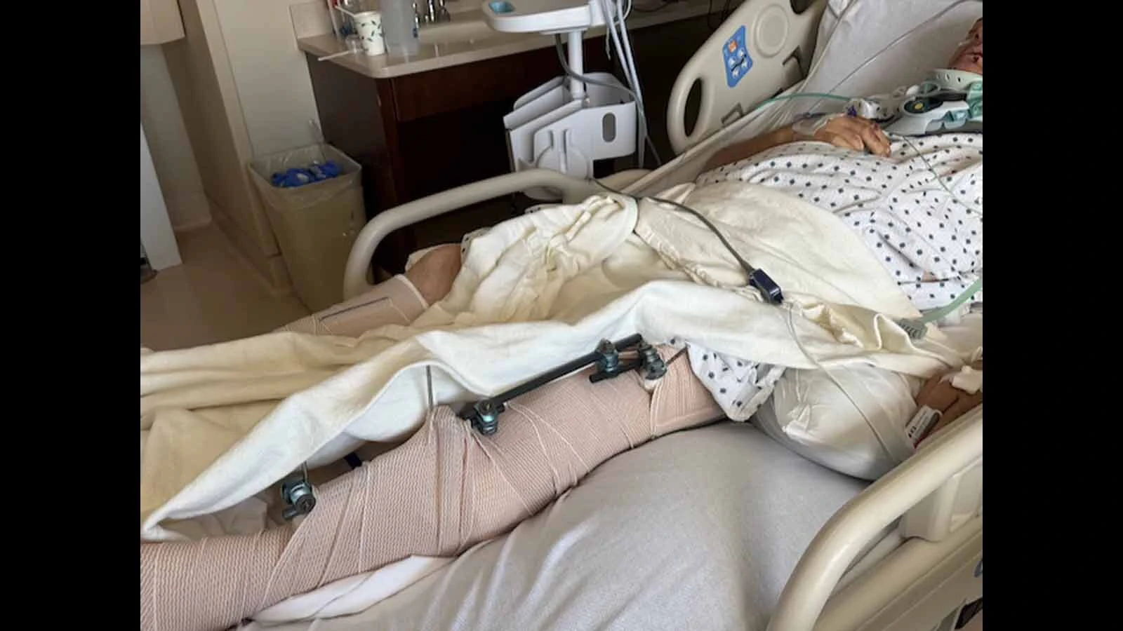 A badly broken leg is among the numerous injuries Roger Davis suffered in a devastating crash on Aug. 25.