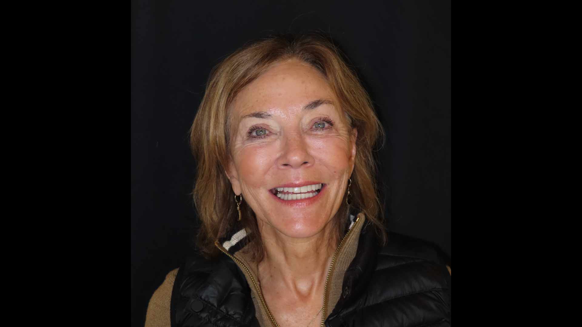 After photo of Mary Ann Murphy, Patient at Aspen Ridge Dental.