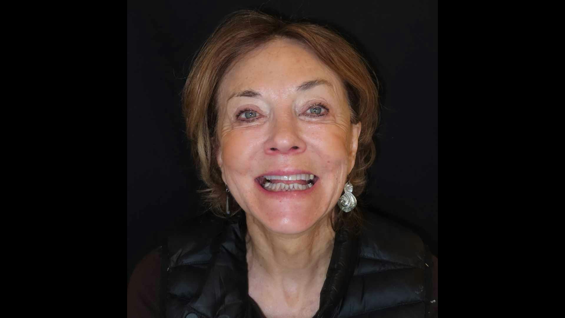 Before photo of Mary Ann Murphy, Patient at Aspen Ridge Dental.