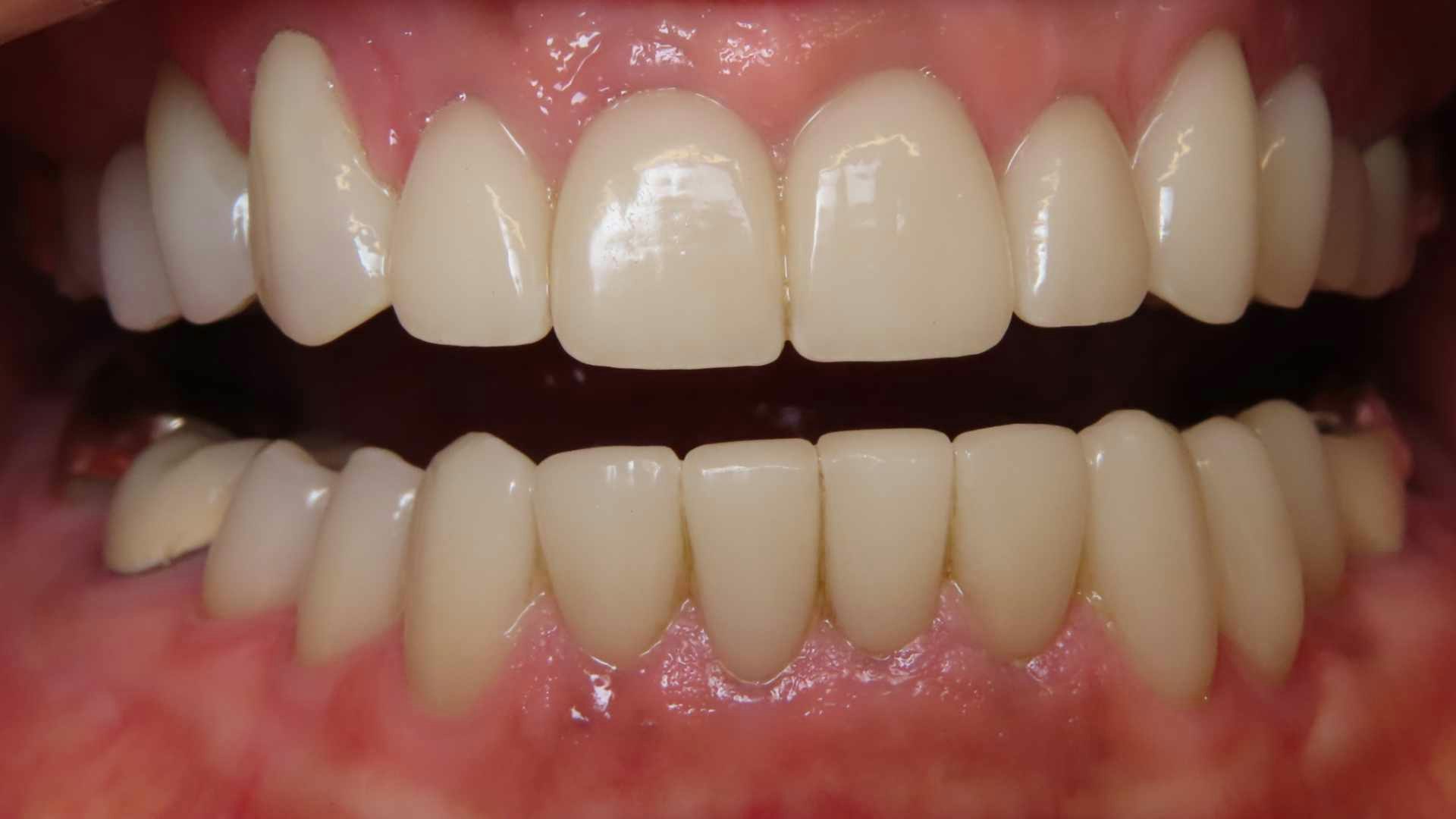 Before and after teeth images.