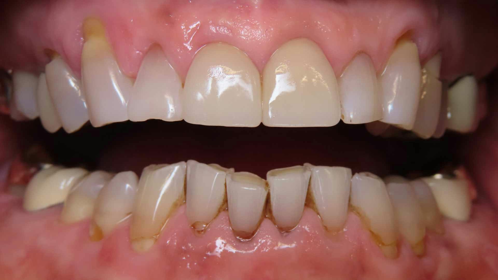 Before and after teeth images.