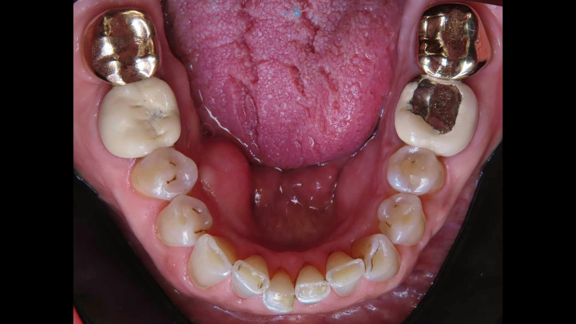 Before and after teeth images.