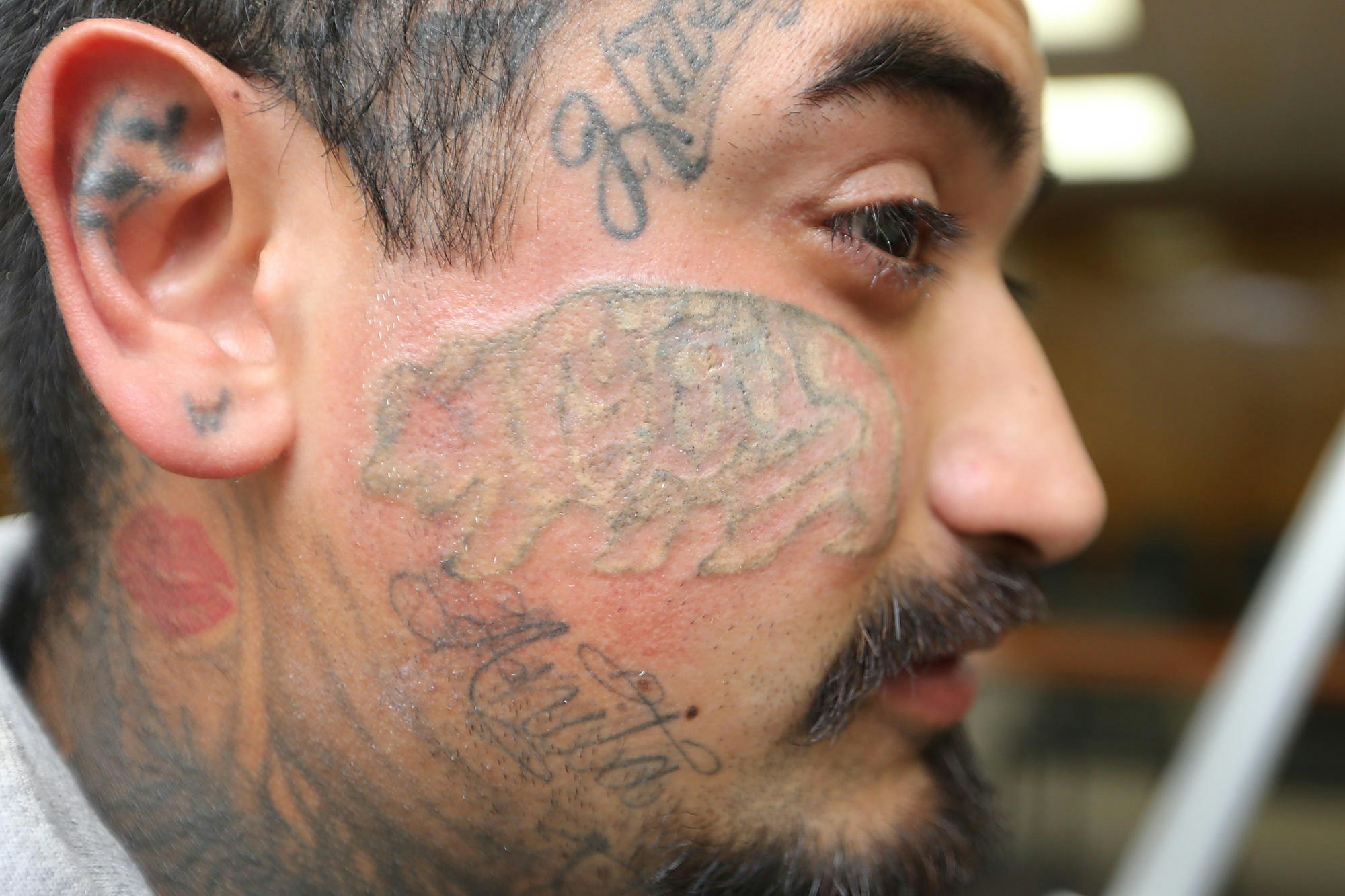 Tattoo removal takes several treatments weeks apart and can be costly.