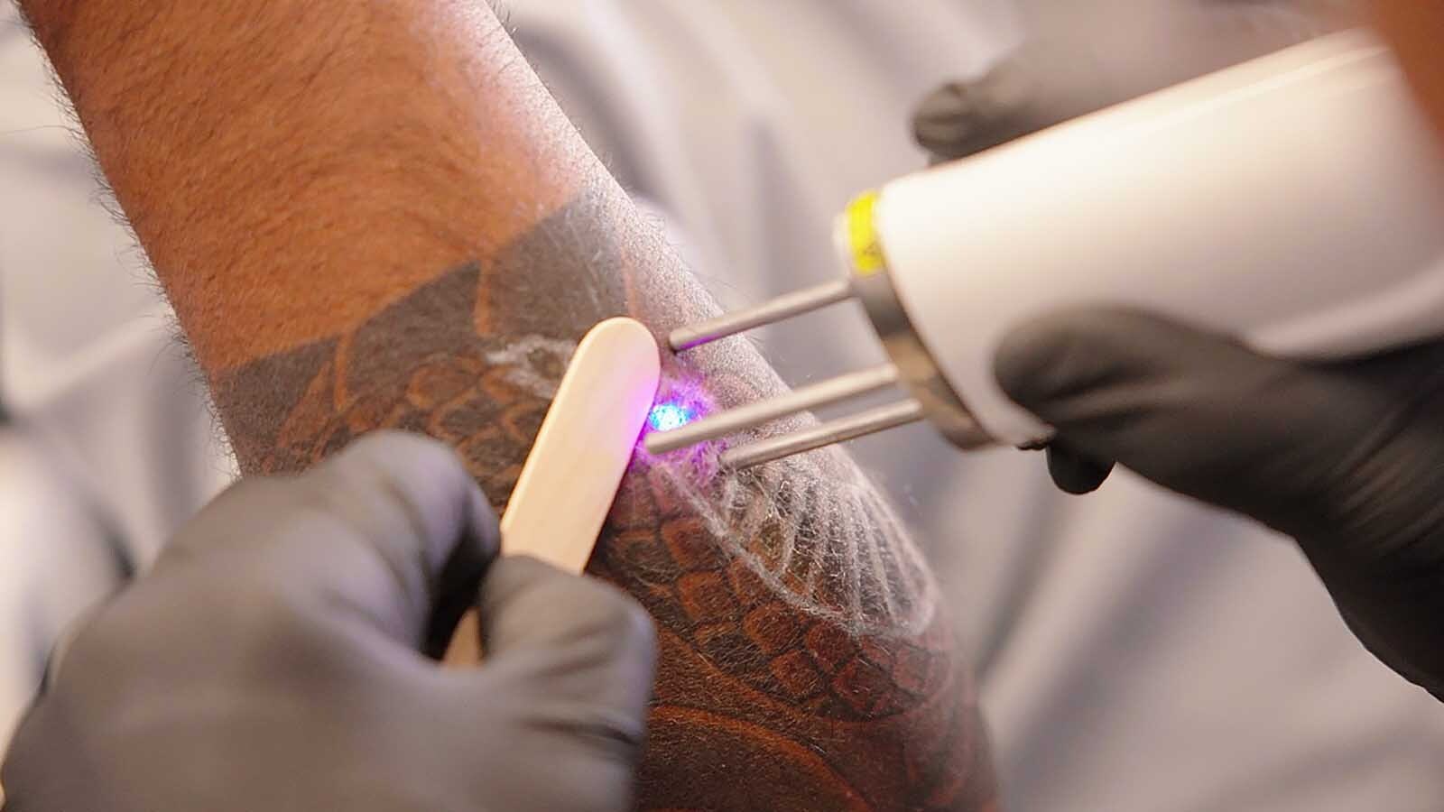 Jeff Garnett started as a customer looking to erase tattoos and replace them with new ones. Then he co-founded Inkless and continues to clear his personal skin slate, making room for new, better tattoos.