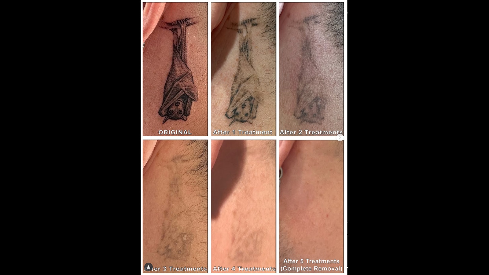 It started off as a good idea, but years later, not so much. So Inkless co-founder erased the bat behind his ear.