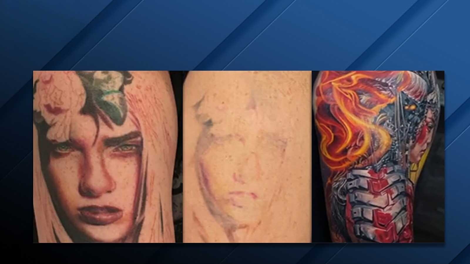 Whether it’s a total tattoo removal or a lightening process that allows an artist to add a brand new tattoo on top of the old one, sessions are spread out over weeks and months and can take up to a year for certain really dark, embedded tattoos.