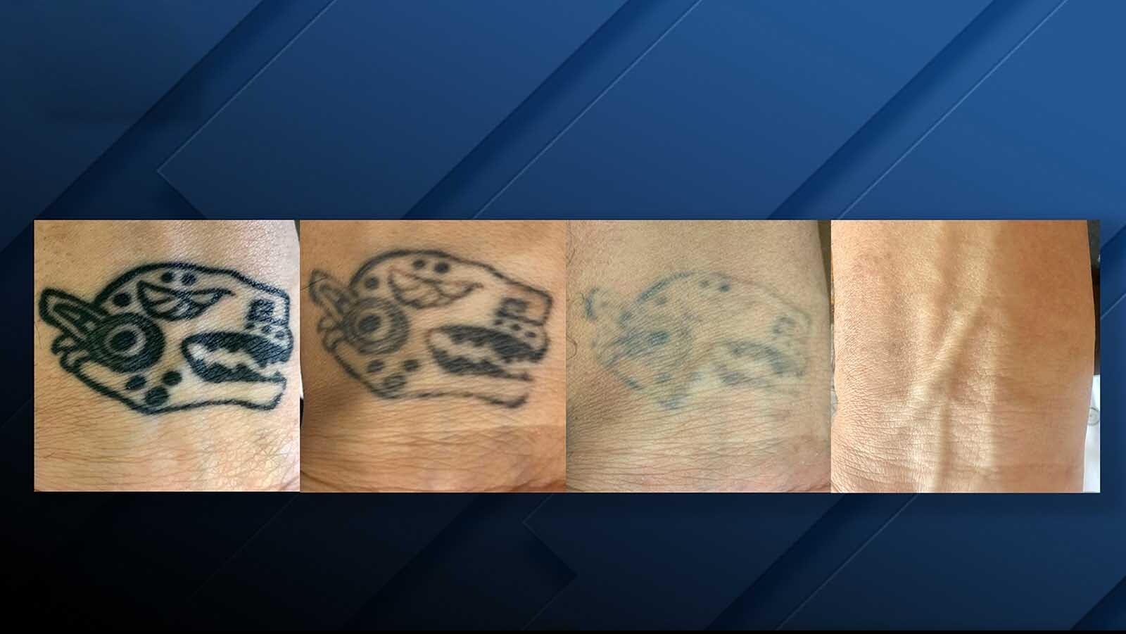 Whether it’s a total tattoo removal or a lightening process that allows an artist to add a brand new tattoo on top of the old one, sessions are spread out over weeks and months and can take up to a year for certain really dark, embedded tattoos.