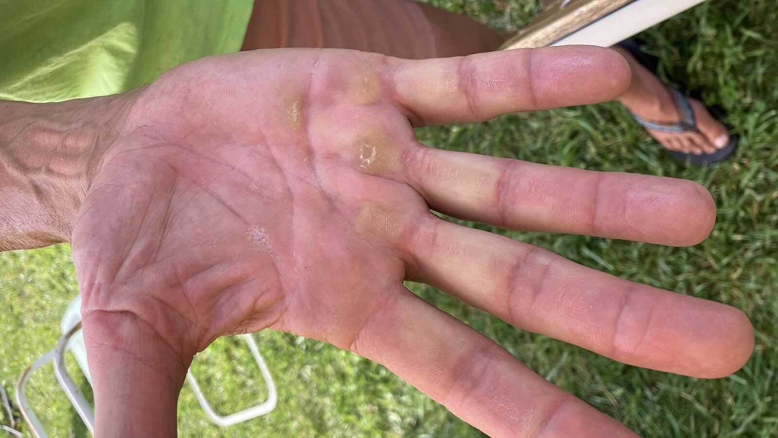 The hand of Steve Tobi gets calloused in his role as catcher. He has to climb a rope to get to his trapeze.