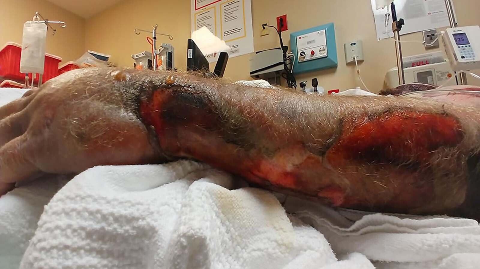 As part of his recovery from severe burns, Travis Clyde’s family reports he has had three surgeries.