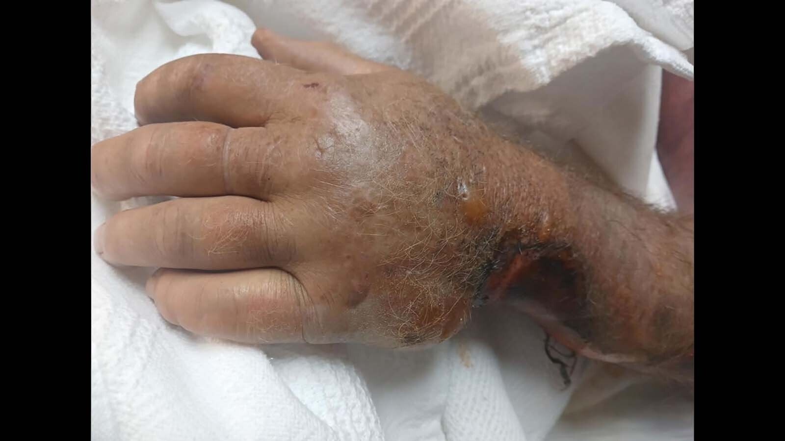 Travis Clyde’s hand on July 18 after being life-flighted to the University of Utah Burn Center.