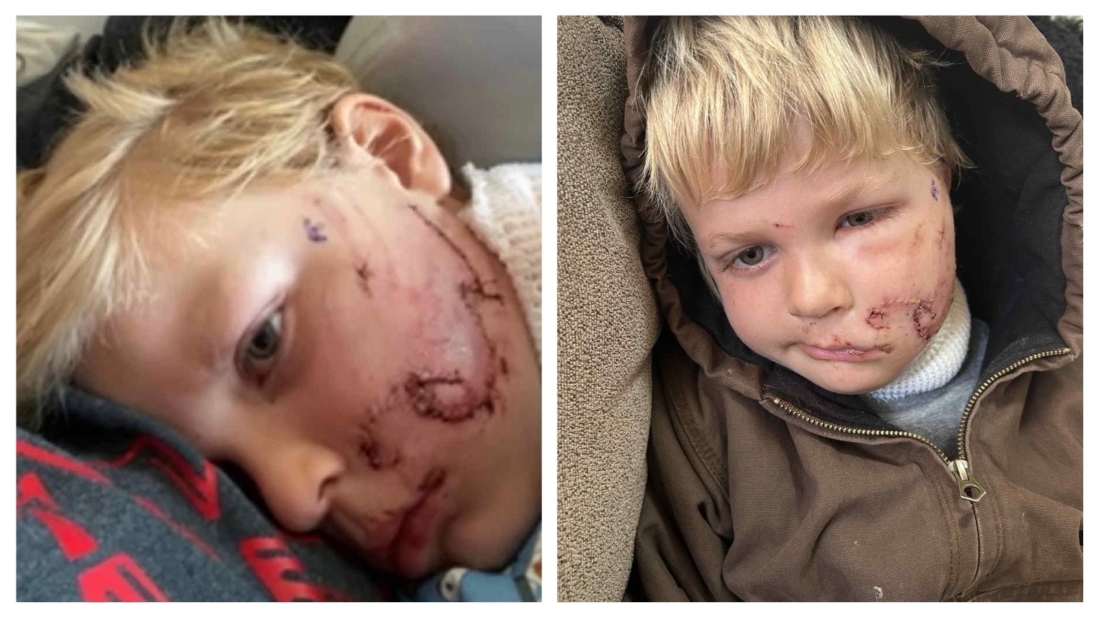 Leo Feller, 5, of Hurricane, Utah, suffered a brutal dog attack that left him with severe facial injuries. The attack is similar to one suffered by Bridger Walker of Cheyenne, who was then 6 and now 11, who had to get 90 stitches to sew up his face when he got between a vicious dog to save his younger sister.