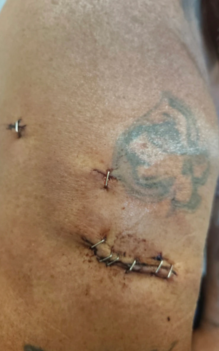 One of Brian’s arms after the bear attack.