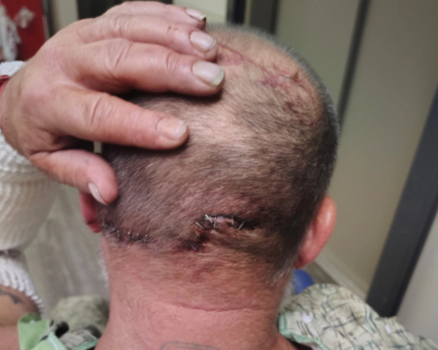 The back of Brian’s head after receiving staples from the bear attack.