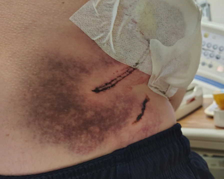 Brian’s torso after the bear attack.
