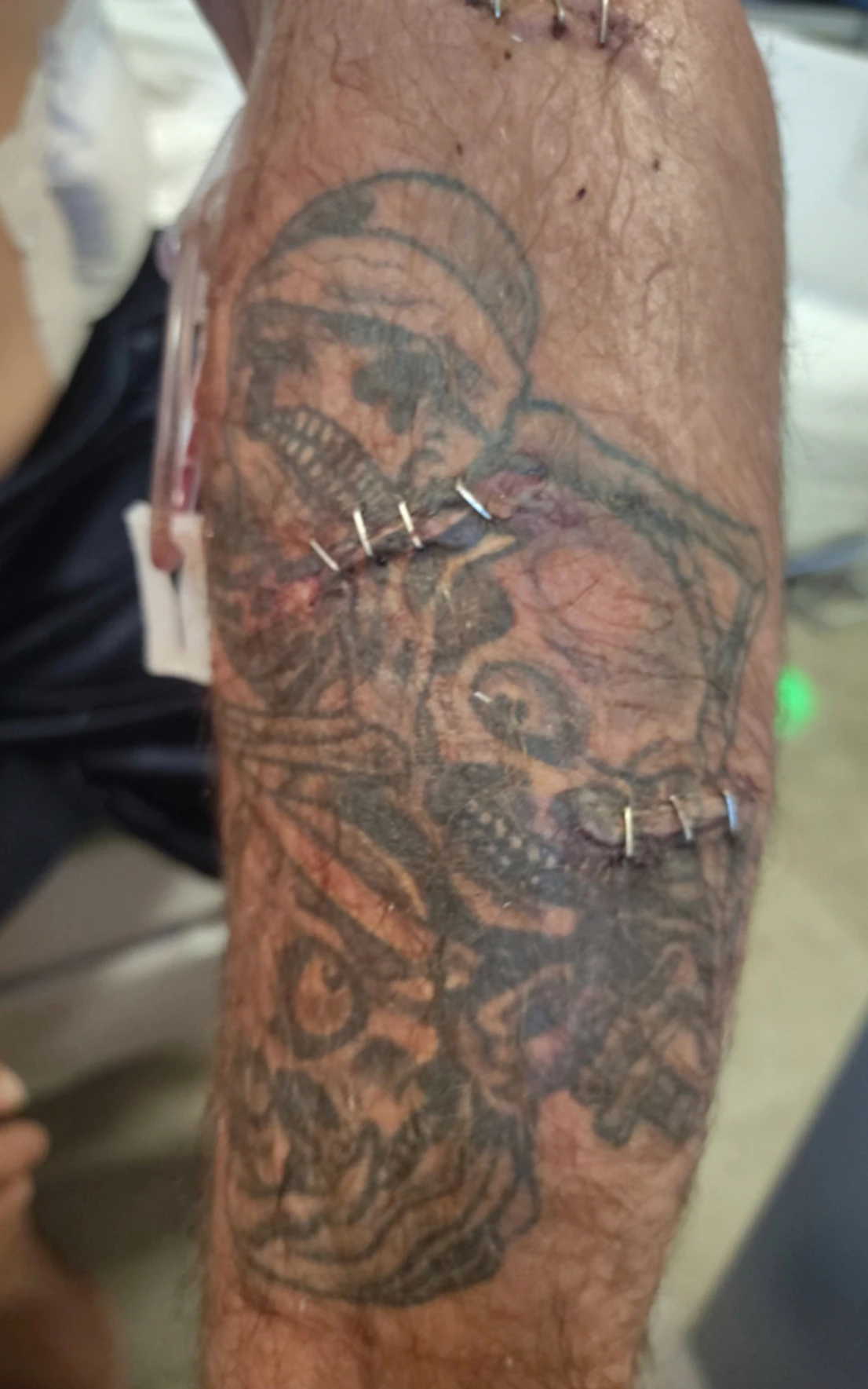 One of Brian’s arms after the bear attack.