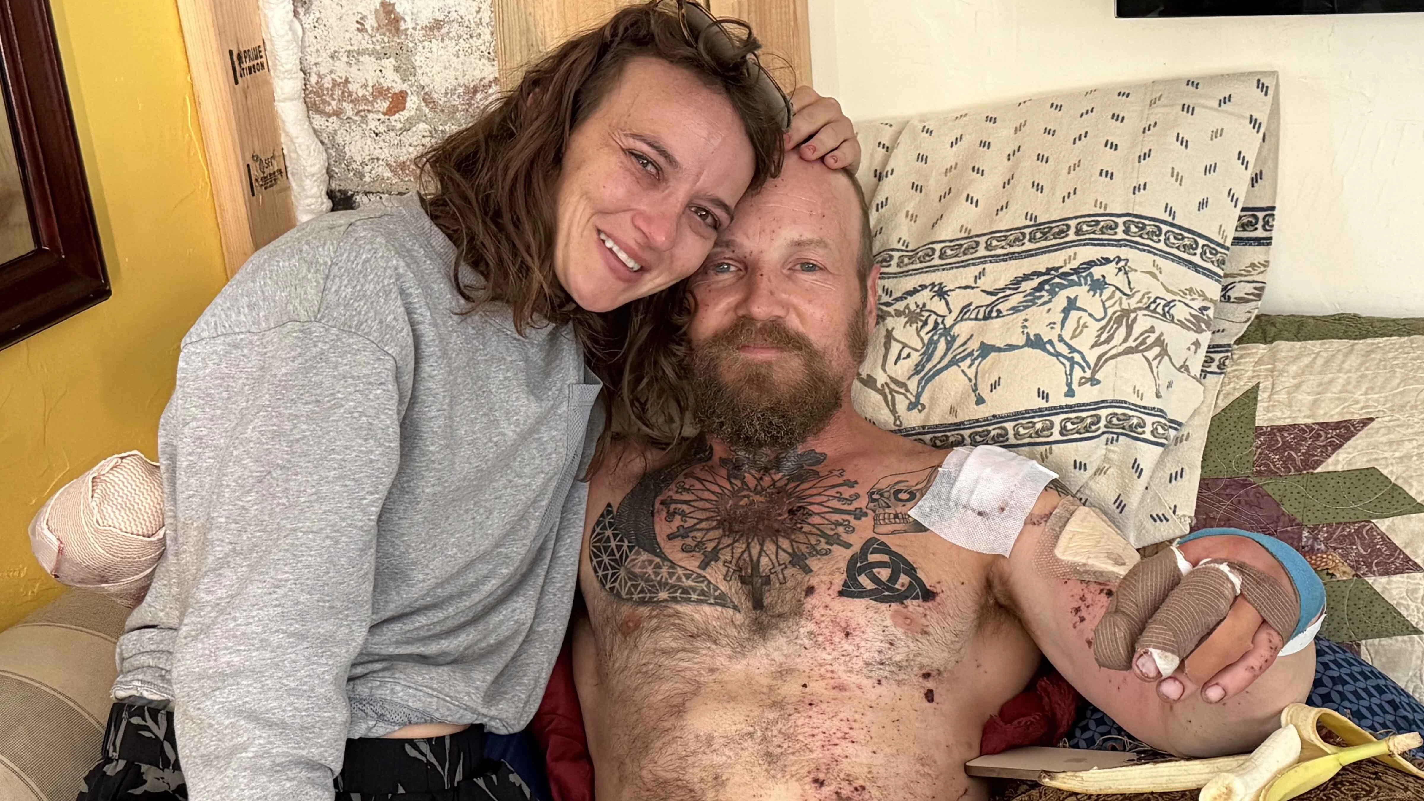Lynch recovers at home with Kathryn Schwartz, the mother of their 5-year-old son, whom he says has not left his side since the Fourth of July fireworks explosion severely injured both of his hands