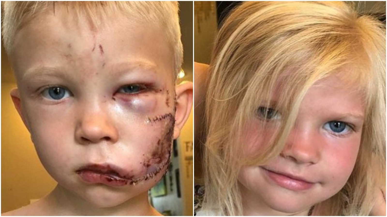 Bridger Walker was 6 when he stepped in front of an attacking dog to save his 4-year-old sister Brielle. It took 90 stiches to close up the wounds from the attack. “If someone had to die, I thought it should be me," he said after the attack.