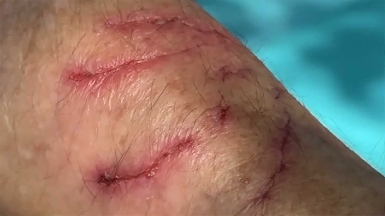 A squirrel in California’s San Fransico Bay area has gone rouge, attacking at least five people, sending two to the emergency room. Wyoming biologists say squirrels may look cute but can be meaner than people realize. Isabel Campoy suffered severe scratches to her arm.
